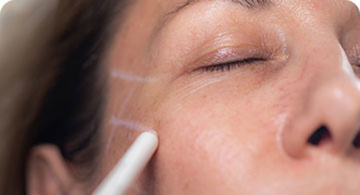 Treatment at Youth Skin Rx, promoting skincare benefits for rejuvenated and glowing skin