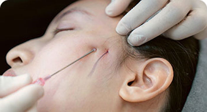 RF Microneedling Treatment at Youth Skin Rx, offering skincare solutions for radiant and healthy skin.