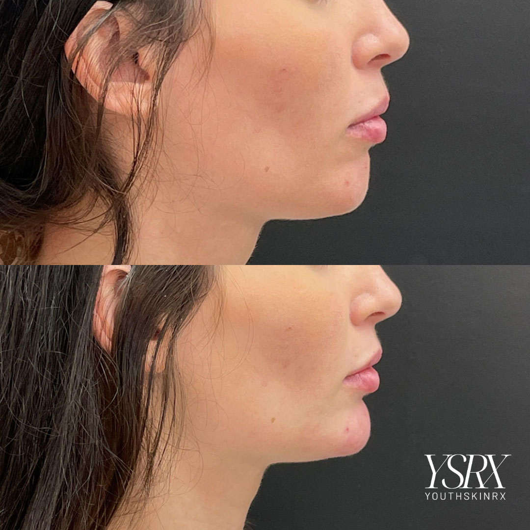 Dermal Fillers treatment before and after results of skincare transformations at Youth Skin Rx, featuring aesthetic enhancements.