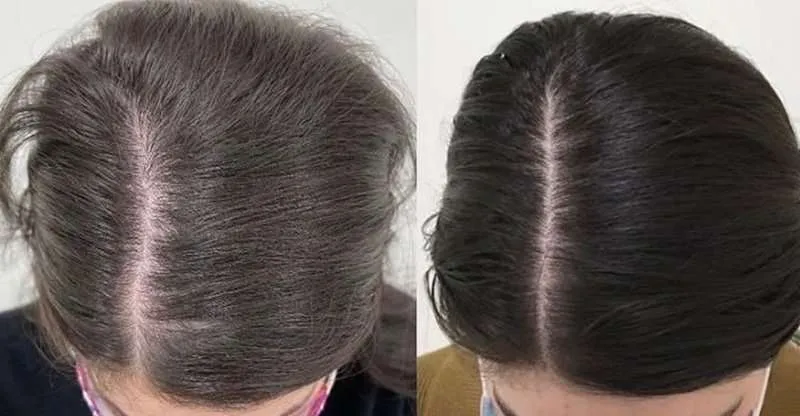 Before-and-after comparison of exosomes hair loss treatment, showcasing transformative results at Youth Skin Rx.